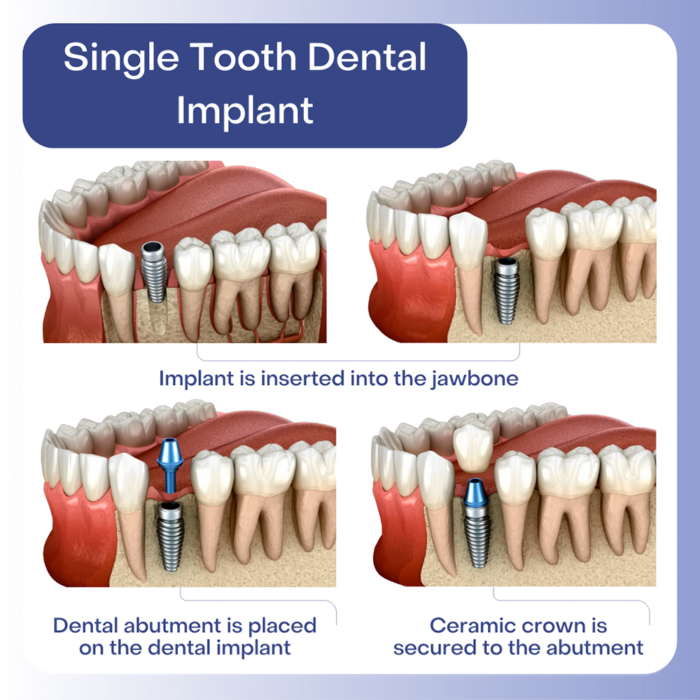 Dental Implants