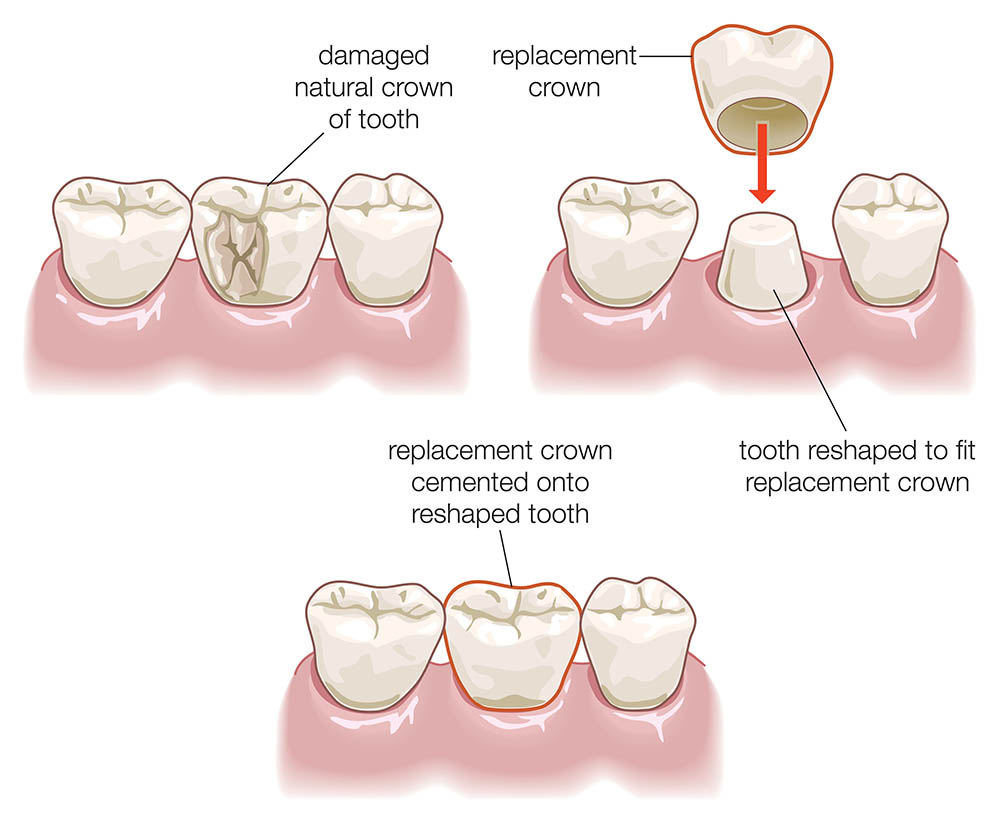 Dental Crown Procedure
